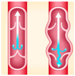 Varices